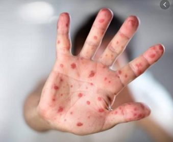 Bệnh Chân Tay Miệng